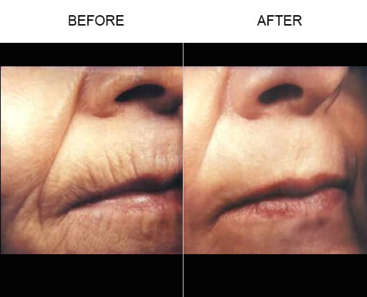 Laser Skin Resurfacing Before And After